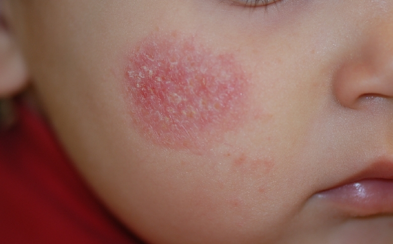 Dermatite 6 anni. Dermatite 6 anni - daisysara.ro