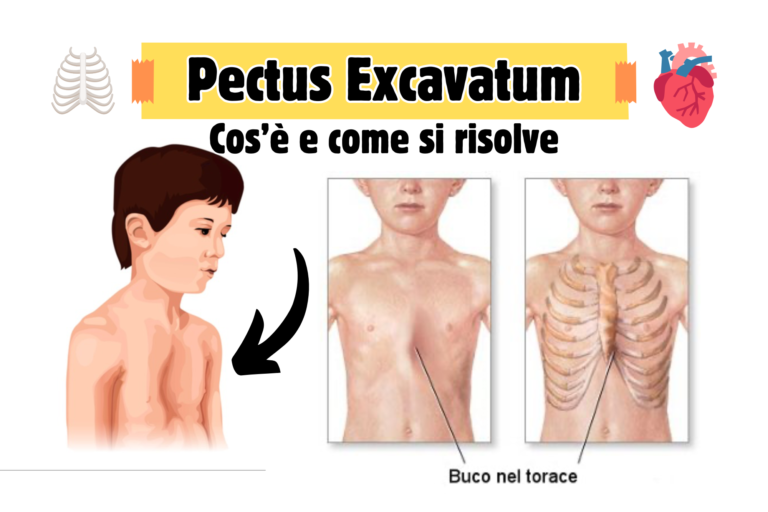 Petto escavato per 1 ragazzo su 300. La soluzione con una 'campana sottovuoto' all'Ospedale Niguarda di Milano