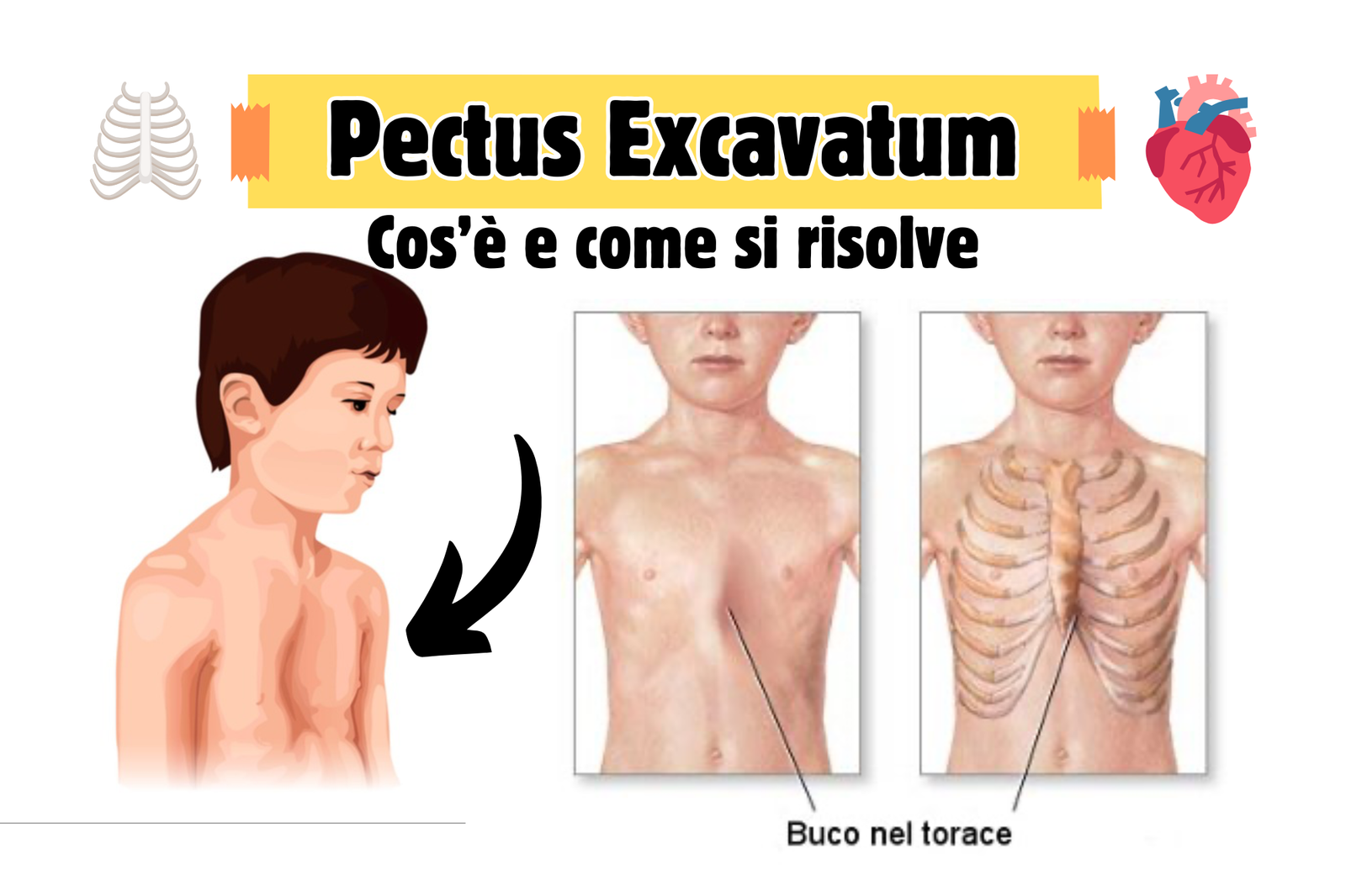 Campana A Vuoto Per Pectus Excavatum | Tutore Morbido Per Sterno Incavato E Torace A Imbuto - Correzione Fisica Non Invasiva Con Manometro, Lavabile (Taglia L-L)