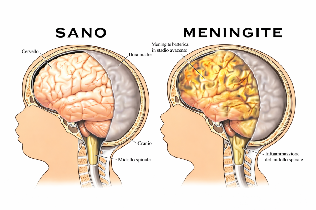 Meningite nei Bambini: Guida Pratica per Riconoscere i Sintomi e Agire Subito